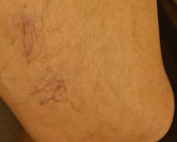 Help!! Thread veins are so ugly