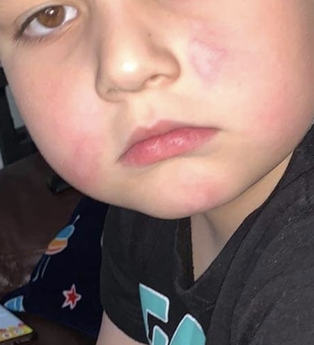 Sickness bug/hives