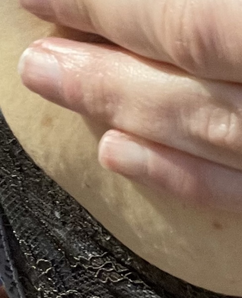 Very scared large indent in side of breast