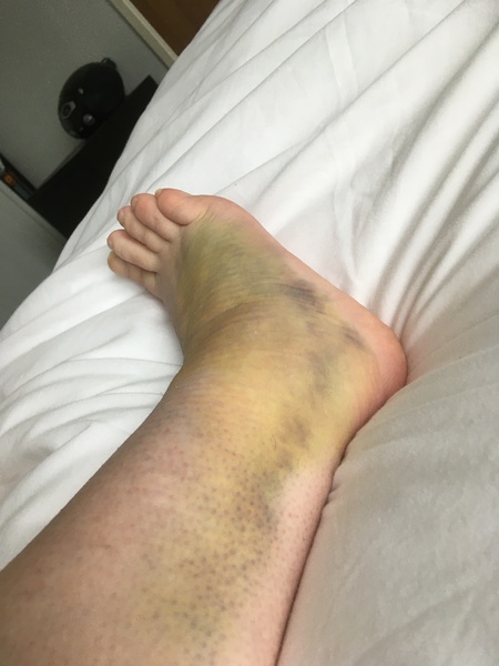 5th metatarsal fracture recovery