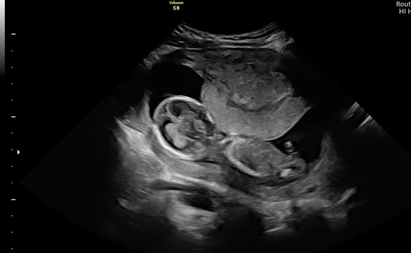 Anyone else had a placenta like this?