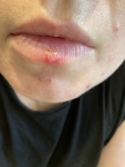 Please help: is this a cold sore?
