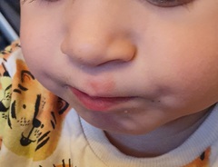 19 month old red mark/skin above upper lip..