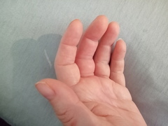 Tendonitis treatment? Fat fingers!
