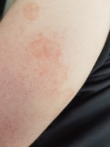 What is this rash? (with pictures)