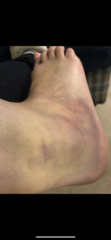 Would you go to a&e if you thought you had sprained your ankle?