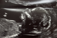 Boy or girl scan pics