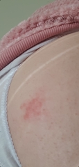 Weird rash on buttock (pic included)