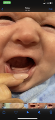Teething??? Thrush?? Epstein pearls??