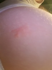Weird rash on buttock (pic included)