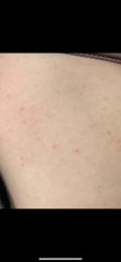 Help me identify this rash