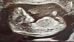 Boy or girl: any ideas?