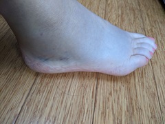 Would you go to a&e if you thought you had sprained your ankle?
