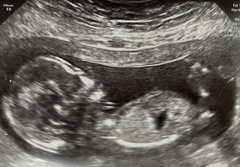 Boy or girl scan pics