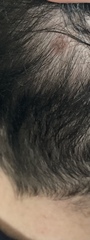 What’s this on scalp? Flat brown marks?