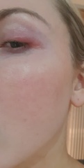 Swollen and very painful eyelid