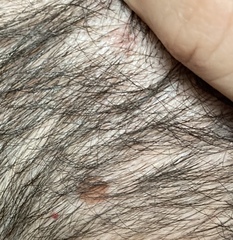 What’s this on scalp? Flat brown marks?