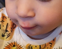 19 month old red mark/skin above upper lip..
