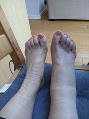 Would you go to a&e if you thought you had sprained your ankle?