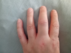 Tendonitis treatment? Fat fingers!
