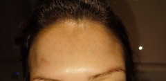 Fall from height and dent on forehead *pic included*