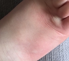 Toddler with covid foot?