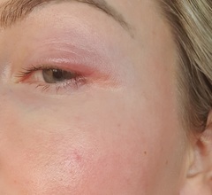 Swollen and very painful eyelid