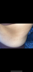 Please help! Huge rash getting worse