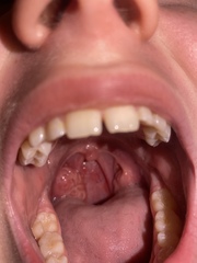 One massive tonsil- should I be worried? Warning - Pictures