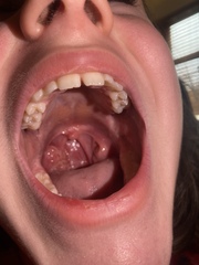 One massive tonsil- should I be worried? Warning - Pictures