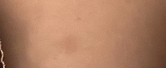 Strange mark on breast, what could it be?