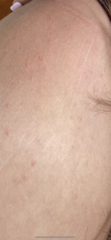 Help me identify this rash