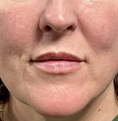 Lip fillers - help!