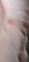 Red spots on body. Bed bugs?