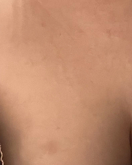Strange mark on breast, what could it be?