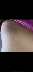 Please help! Huge rash getting worse
