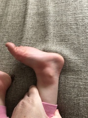 Toddler with covid foot?