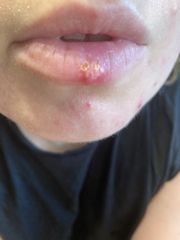 Please help: is this a cold sore?