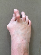 Undeserved bunions