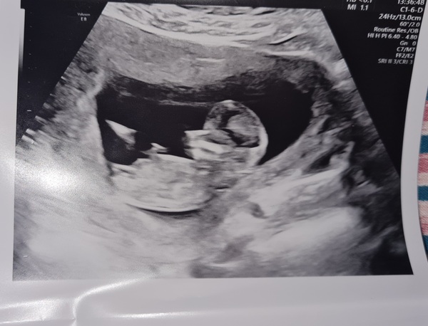 12 week scan gender