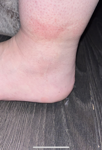 Could a sprained ankle cause limping or something else?