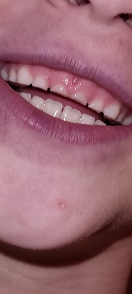 Advice on DS teeth (pic attached!)