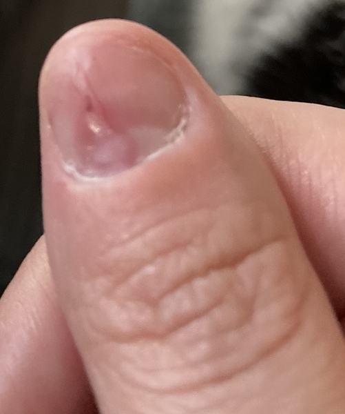 Help - messed up nail - acrylics **pic warning**