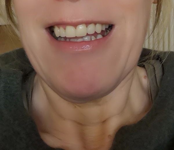 AIBU to think people are ruining their teeth with veneers
