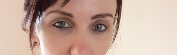 Treatment for undereye hollows/darkness