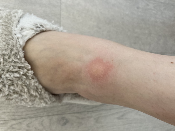 What’s bitten me?