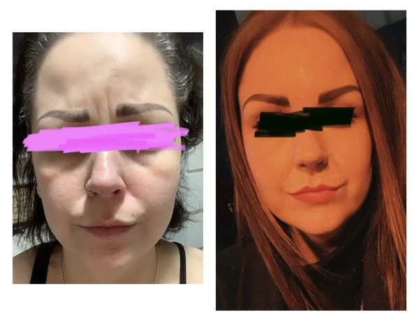 For those of you who have Botox injections…