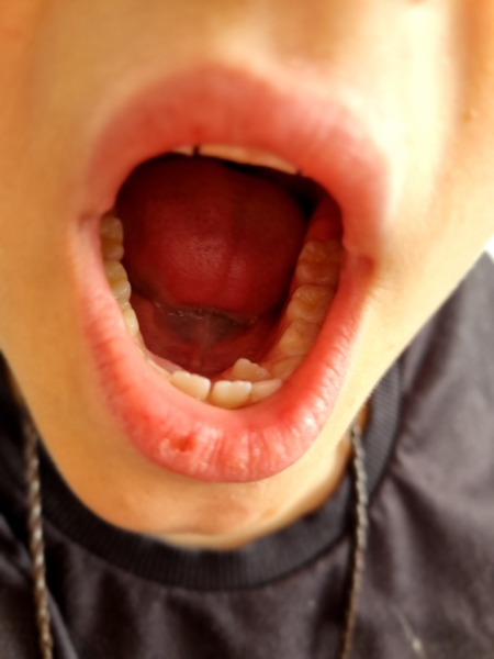 Advice on DS teeth (pic attached!)