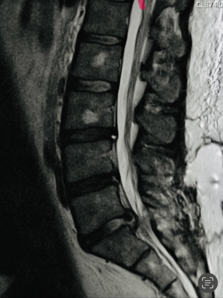 Could this be cauda equina