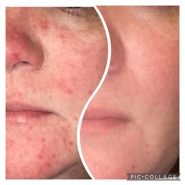 Rosacea Type 2 - Soolantra/Ivermectin/Dermatica